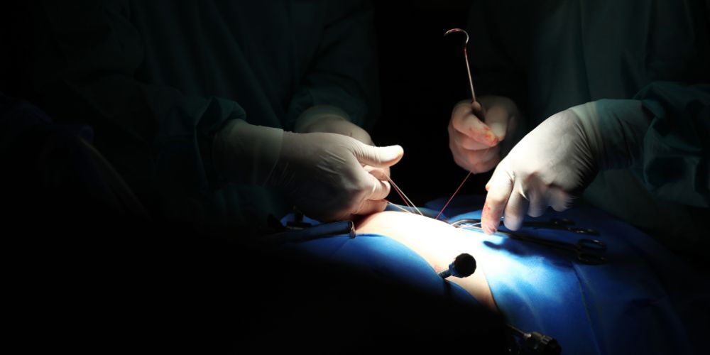Kannattaako lihavuusleikkaus? — Health Clinic Laihdutusklinikka Lihavuusleikkaus tehokkaana apukeinona laihtumiseen ja pysyvään painonhallintaan nousee esiin. Jo leikkauksen ajatteleminen itsessään nostaa mieleen lisää kysymyksiä. Saatat kysyä itseltäsi: Uskallanko? Tuoko leikkaus minulle niitä terveyshyötyjä mitä odotan vai onko kaikki vaan kauniita sanoja? Nämä kysymykset on tärkeää tiedostaa ja kysyä itseltään sekä etsiä niihin vastauksia. Tämä kaikki on osa valmistautumista mahdolliseen leikkaukseen tähtäimessä oman elämänlaadun parantaminen.