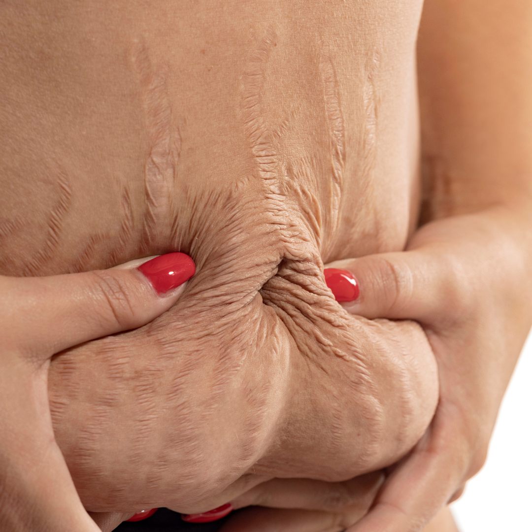abdominoplastia virossa